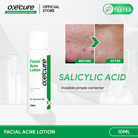 Facial Acne Lotion