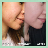 Sulfur Soap 100g [Buy 1, Get 1 FREE]